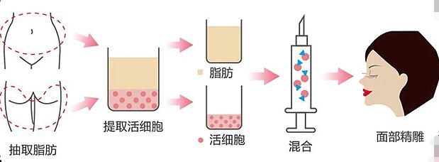 面部脂肪填充