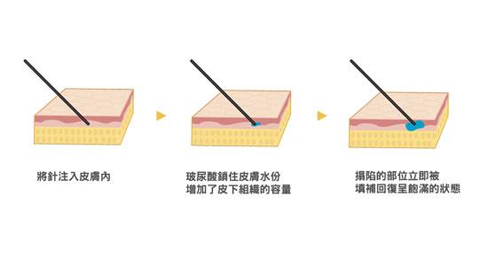 成都做玻尿酸除皺效果能維持多長(zhǎng)時(shí)間