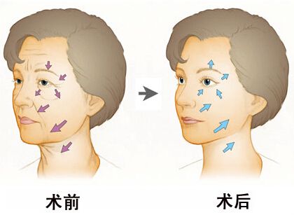 泉州做電波拉皮能維持多長時間