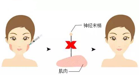 成都瘦臉的效果能夠維持多長時間