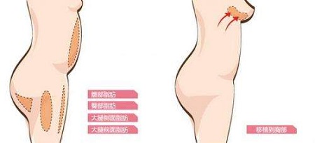 怎么進行乳房再造