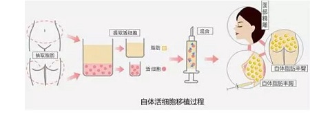 吸脂豐胸多少錢