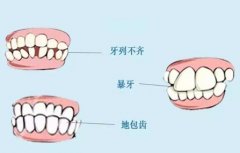 上海做牙齒畸形矯正多少錢(qián)