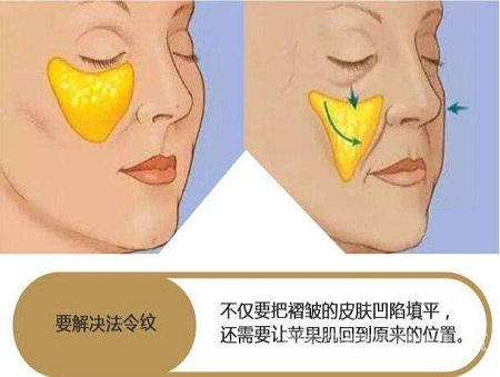 脂肪填充法令紋能維持多少時間？