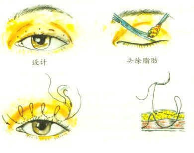 切雙眼皮