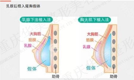 假體豐胸失敗修復價格