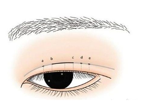廈門(mén)割雙眼皮術(shù)后的疤痕能自然退掉么