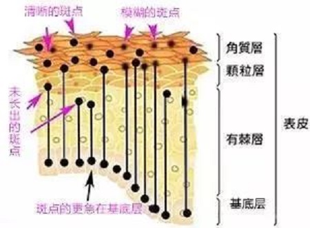 凈斑雪花針