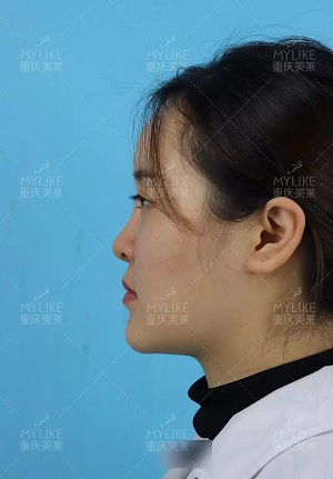 “鼻綜合”后假又歪，還攣縮？鼻修復(fù)還原自然生態(tài)美鼻