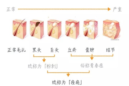 擠痘竟然被送進ICU！你的痘痘還好嗎？