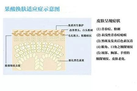 擠痘竟然被送進ICU！你的痘痘還好嗎？