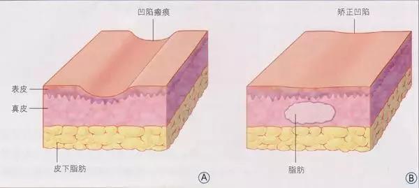 自體脂肪填充為什么需要二次補(bǔ)打？