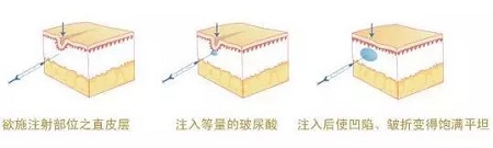 法令紋、川字紋