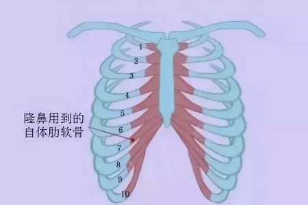 什么，隆鼻方式竟然有這么多種？