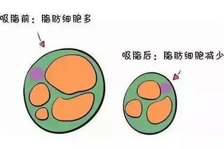 關(guān)于吸脂那些不能說的秘密，今天要在這里一次說完！