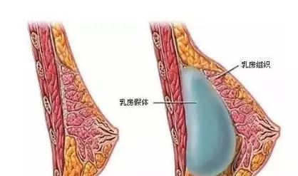 自體脂肪or假體隆胸，我到底應(yīng)該怎么選？