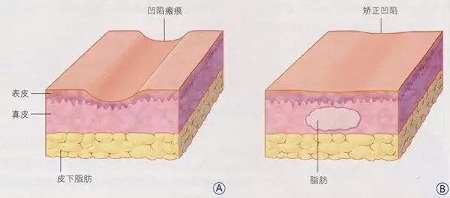 明星的臉和你的臉差的只是這一步！--面部脂肪填充