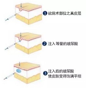 用玻尿酸治療鼻唇溝，一定要注意這種情況！