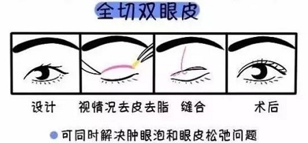 美眼張誠坐診美萊，淺談為什么你的眼睛不夠美？