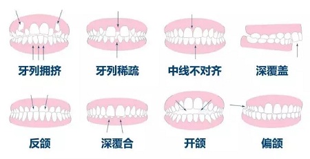 牙齒不齊