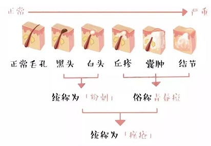 痤瘡的分類