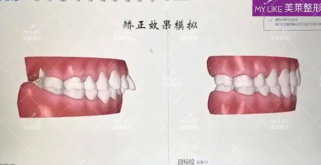 天津美萊口腔·專業(yè)口掃 預(yù)見(jiàn)矯正效果