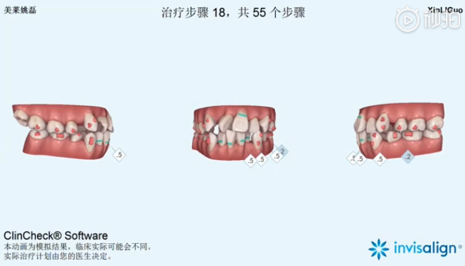 南京美萊口腔全景側(cè)位片，拍照取模，動(dòng)畫(huà)方案設(shè)計(jì)