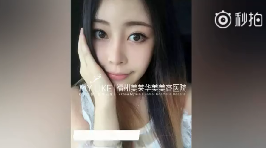 福州美萊鼻子幾毫米的改變，自信百倍的蛻變