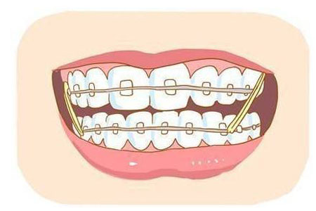 牙齒矯正術后注意什么